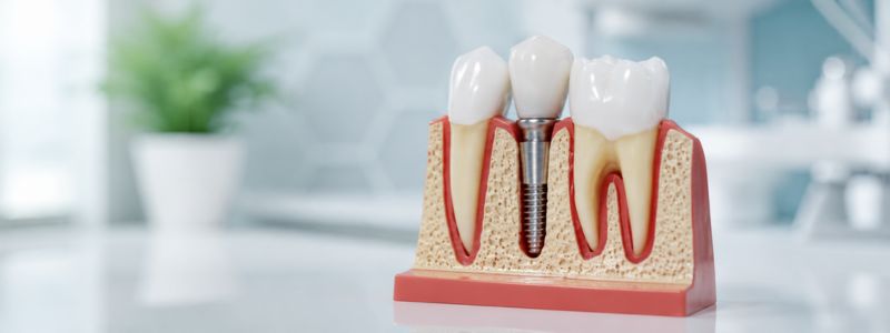 dental implants in Hyderabad