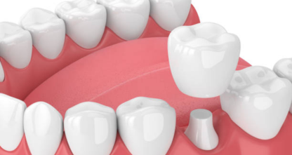 Dental crowns