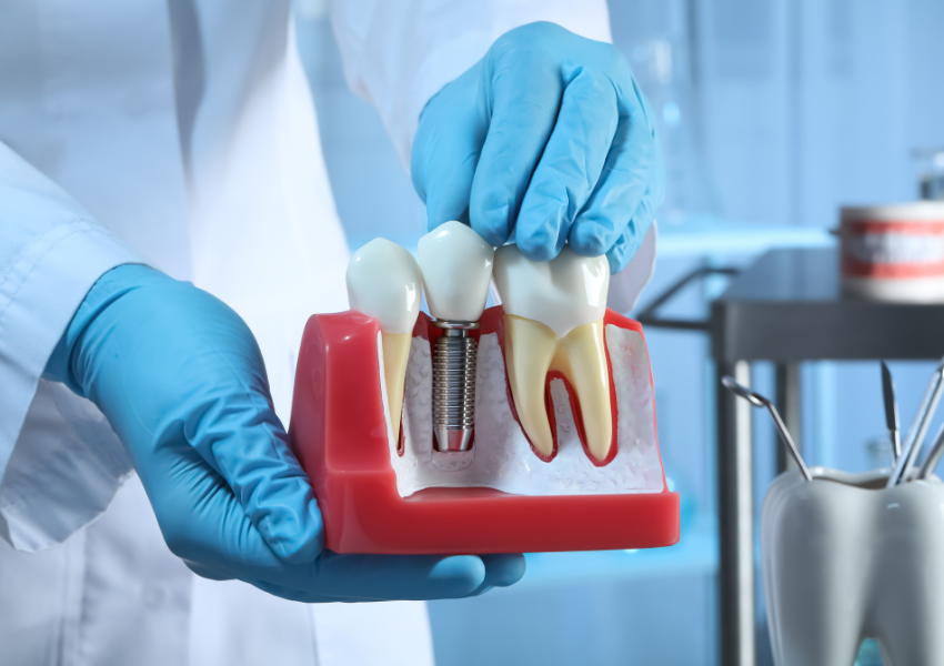 Factors you need to consider before getting Dental Implants