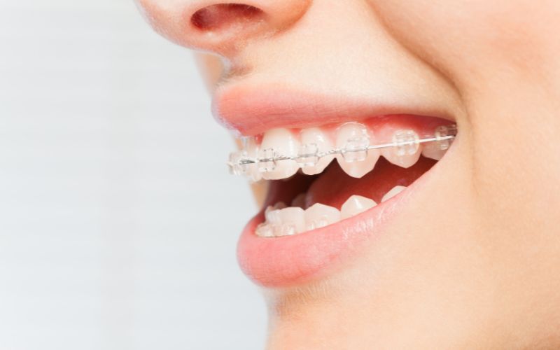 Types of Dental Braces in India Types of Dental Braces in India